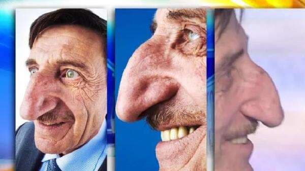 Viral Hidung Terpanjang, Pria Turki Mehmet Ozyurek: Belajar Damai dengan Kondisi Fisik