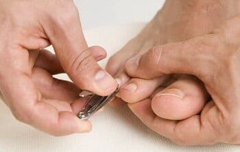 3 Cara untuk Mengobati Cantengan yang Sudah Bengkak