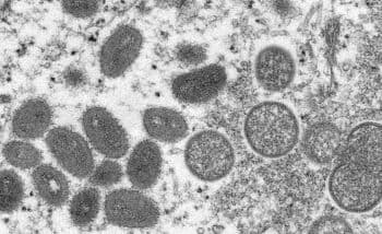 Penis Bengkak dan Nyeri Dubur Jadi Gejala Baru Cacar Monyet?