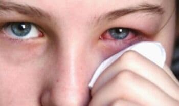 9 Cara Mengobati Mata Bintitan dengan Mudah dan Cepat