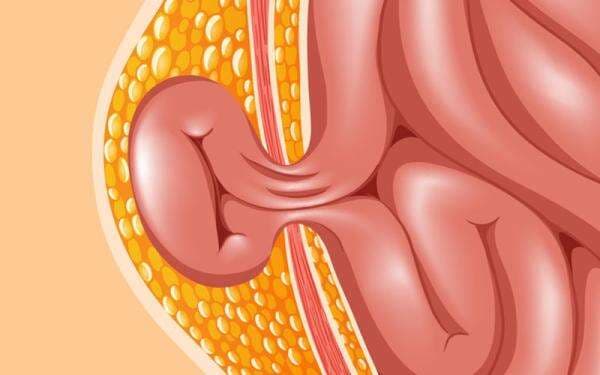 Para Pria, Ini Lho Gejala dan Bahayanya Hernia