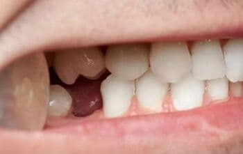 13 Arti Mimpi Gigi Copot, Salah Satunya Bakal Kehilangan Orang Tercinta?