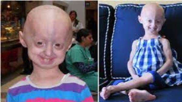 5 Penyakit Langka di Dunia, Nomor 3 Sebabkan Anak Alami Penuaan Dini