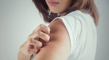 5 Cara Mengobati Biduran agar Tak Kambuh Lagi, Bye Gatal!