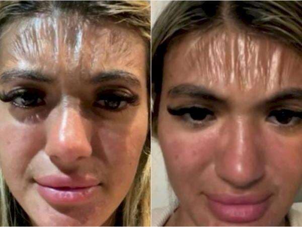 Berjemur Tak Pakai Sunscreen, Dahi Wanita Ini Berubah Jadi Plastik, Ini Bahayanya