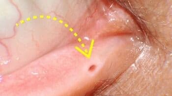 Tahukah Anda, Ada Lubang Kecil di Kelopak Mata, Ini Penjelasannya