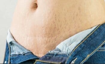 10 Tips Menghilangkan Stretch Mark Secara Alami, Dicoba Yuk Bun!