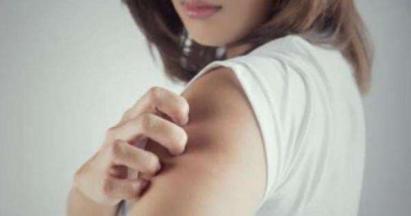 Simak 5 Tips Berikut Ini untuk Mengobati Biduran