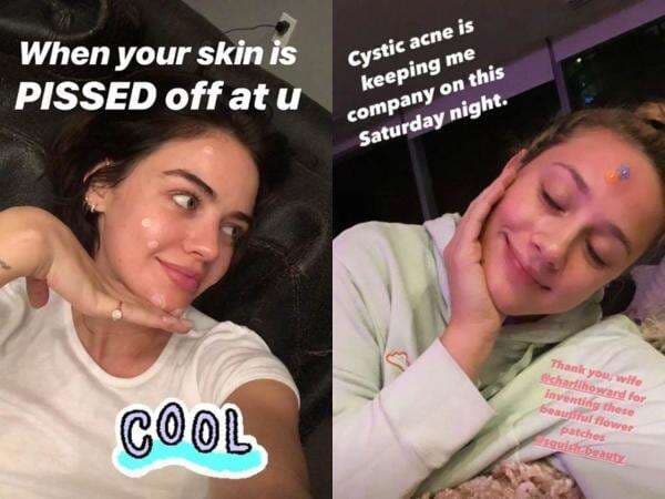 Rayakan Acne Positivity Day, Ini Deretan Seleb Hollywood yang Berbagi Pengalaman Atasi Jerawat