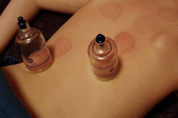 Sebelum Kamu Melakukan Terapi Bekam, Waspadai Efek Samping Ini Sebelum Kamu Melakukan Terapi Bekam, Waspadai Efek Samping Ini