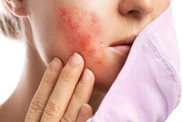 Tips Menghilangkan Jerawat Batu yang Ampuh