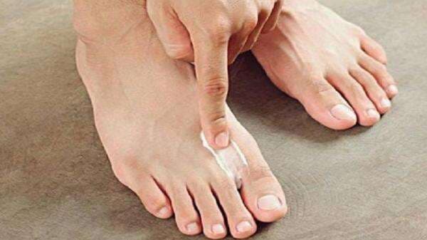 Ini Cara Menghilangkan Kutu Air di Kulit, Obatnya Mudah Ditemukan di Rumah