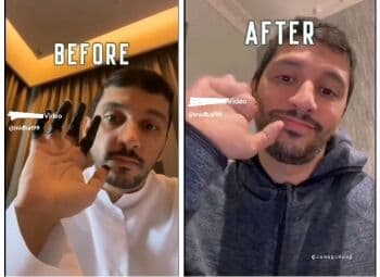 Kenali Penyakit Frostbite, yang Menyebab Seorang Pria Kehilangan Seluruh Jari Tangan