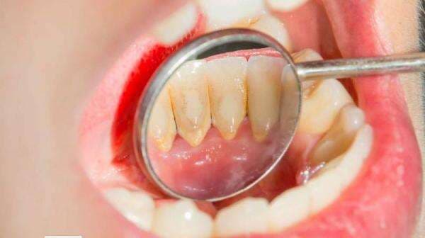 Waspada, Kebiasaan Ini Bisa Menjadi Penyebab Gigi Keropos