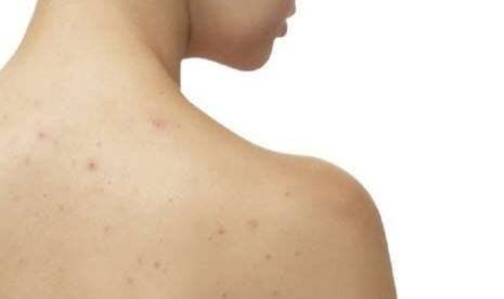 Cara Mengatasi Jerawat 'Bandel' yang Muncul di Punggung