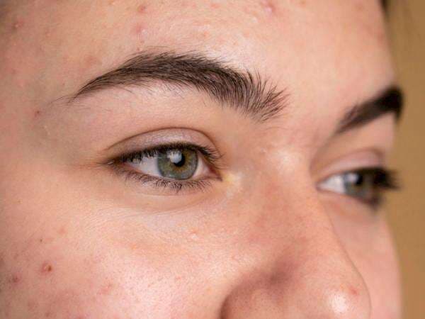 Girls, Yuk Intip Pengertian Milia dan Tips Cara Mencegahnya!