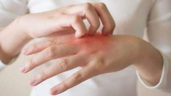 Ternyata Gampang Lho, Ini 3 Cara Atasi Kulit Gatal Gegara Diabetes, Cepat Coba!