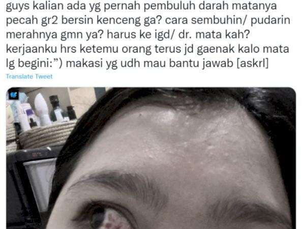Heboh Pembuluh Darah Mata Pecah Akibat Bersin Terlalu Kencang, Ini Penyebab Lainnya!