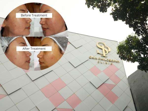 Review: Pengalaman Treatment Chemical Peeling dan VBeam Laser di Skin Philosophy