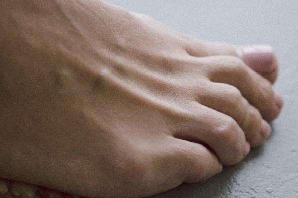 Mengenal Jenis Jamur Kuku dan Penyebab Infeksinya