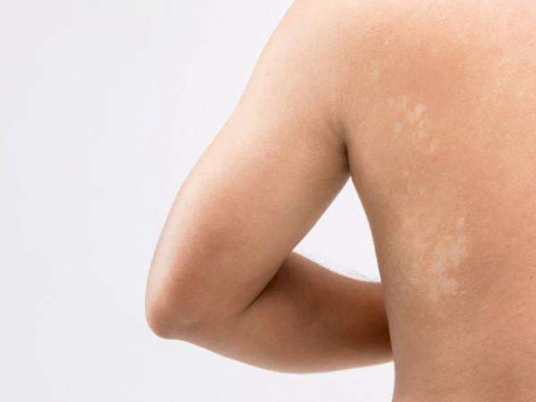 5 Cara Menghilangkan Panu dengan Cepat secara Alami, Ampuh!