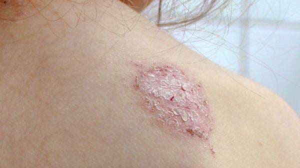 Dermatitis Numularis, Ini Gejala dan Cara Mengatasinya
