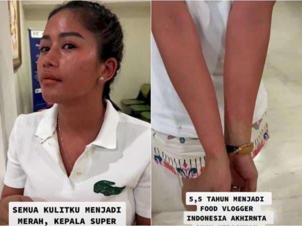 Food Vlogger Farida Nurhan Keracunan Makanan, Seluruh Tubuhnya Memerah