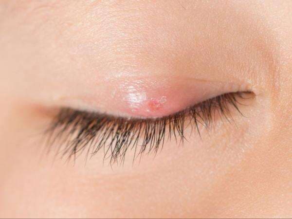 5 Obat Mata Bintitan dari Bahan Alami yang Terbukti Ampuh