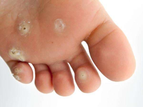 5 Cara Menghilangkan Mata Ikan Alami, Bisa Pakai Sabut Kelapa