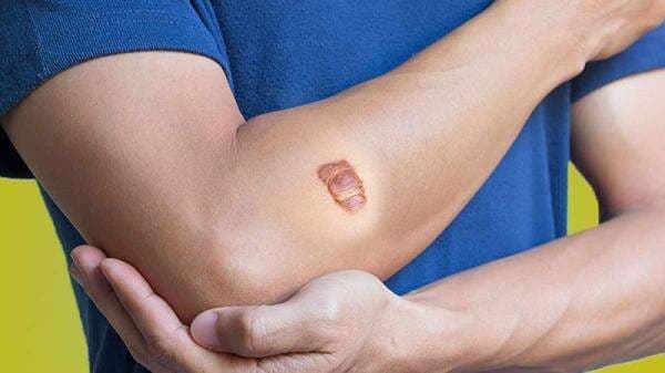 Ketahui Penyebab dan Cara Menghilangkan Keloid, Perhatikan Faktor Risikonya