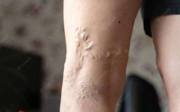 Penyebab Varises di Kaki dan Cara Mengatasinya, Waspadai 6 Gejala Ini