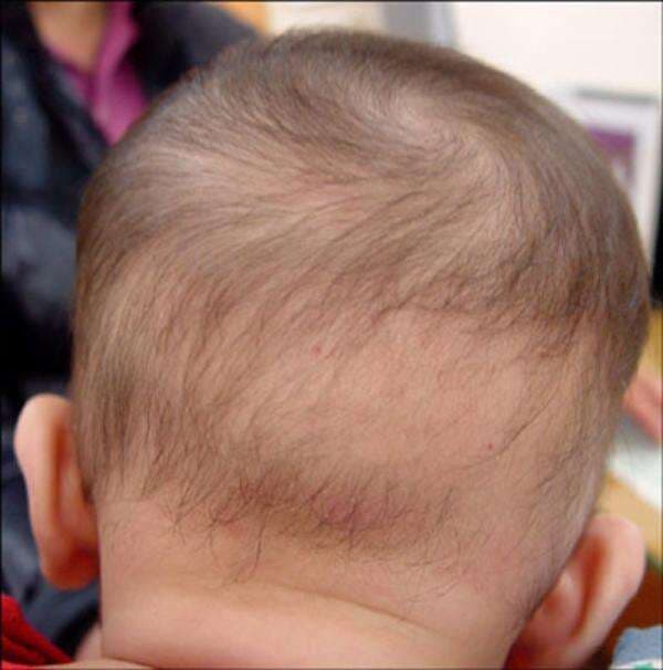 Penyakit Alopecia Areata Pada Anak, Bisa Sebabkan Botak