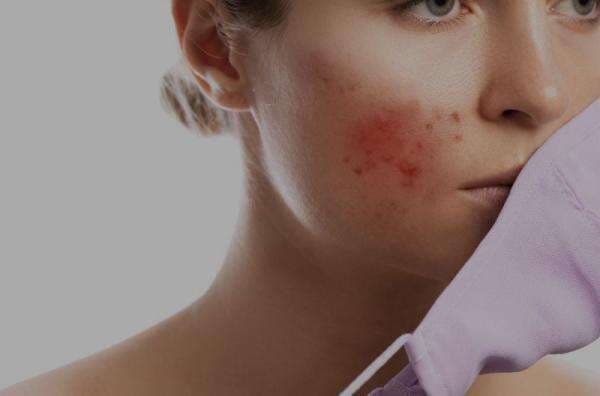 Apa Itu Folikulitis? Ini Beberapa Hal yang Harus Diketahui