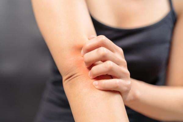 Kenali Gejala Neurodermatitis, Terasa Gatal Saat Anda Stres