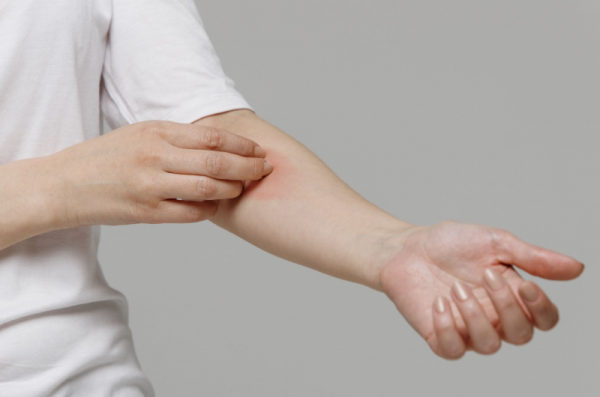 Kenali Penyebab dan Cara Mengobati Bisul