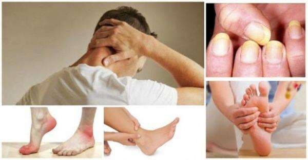 5 Gejala Kolesterol yang Bisa Terlihat Jelas dari Kulit, Begini BentuknyaÂ