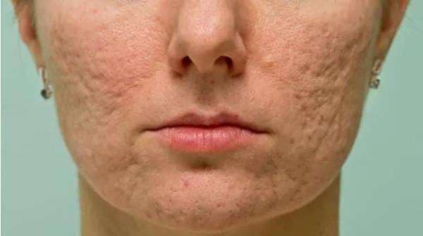 16 Cara Menghilangkan Bopeng Bekas Jerawat Di Wajah