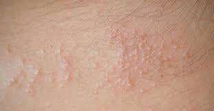 5 Cara Mengobati Biang Keringat