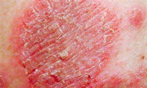 Eksim Pada Kulit Anak: Penyebab, Gejala, dan Pengobatan yang Tepat