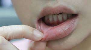 5 Rekomendasi Obat Kumur Sariawan yang Bisa Kamu Andalkan