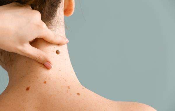 Ketahui 7 Makna Tahi Lalat Berdasarkan Letaknya Di Tubuh Ketahui 7 Makna Tahi Lalat Berdasarkan Letaknya Di Tubuh