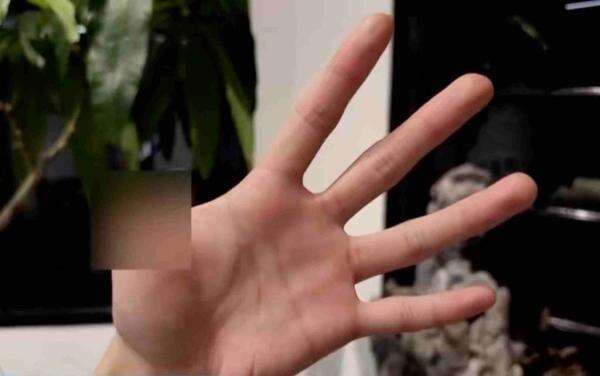 Viral! Jari Pria Ini Diamputasi Usai Digigit Hewan Peliharaannya