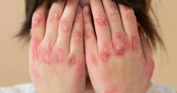 Mengenal Lupus, Penyakit Autoimun yang Dijuluki Seribu Wajah Mengenal Lupus, Penyakit Autoimun yang Dijuluki Seribu Wajah
