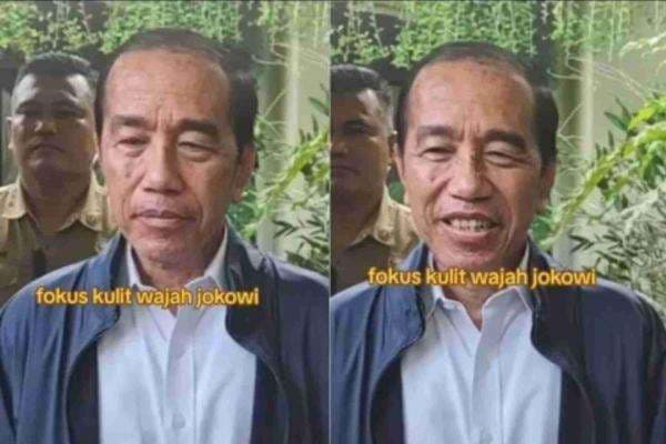 Jokowi Diduga Mengidap Sindrom Stevens Johnson, Apa Itu SJS?
