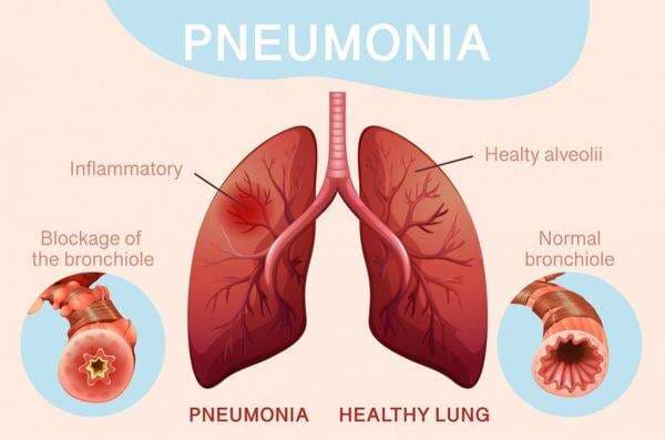 Hari Pneumonia Sedunia, Penyakit Paling Mematikan bagi Bayi