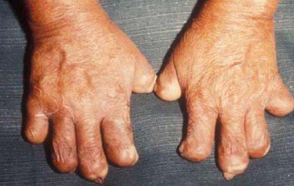 WHO Minta Penderita Kusta Tidak Didiskriminasi