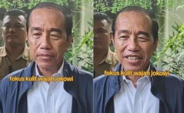 Jokowi Diduga Terkena Sindrom Stevens Johnson: Penyakit Kulit Langka, Apa Berbahaya? 