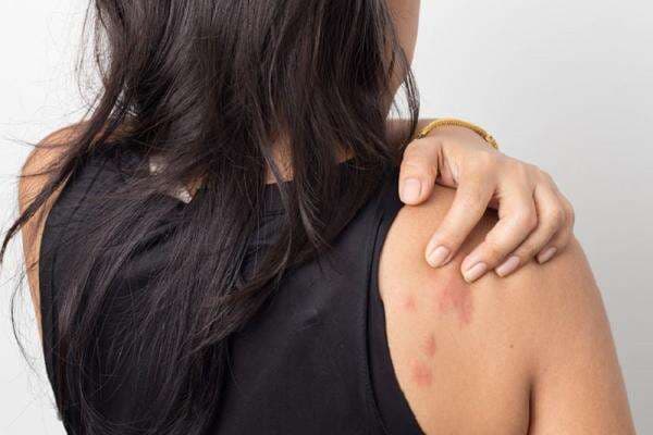 Awas Gatal! Ini 5 Tips Mengatasi Biduran di Musim Hujan