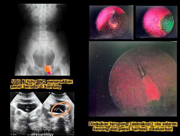 Mengejutkan, Sebatang Pensil Ditemukan di Kandung Kemih Anak 12 Tahun
