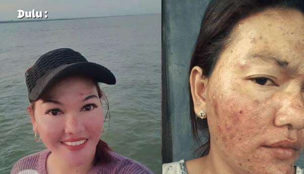 Viral Kisah Kecanduan Skincare Abal-Abal Selama 10 Tahun, Pengguna: Cantik Hanya di Awal
